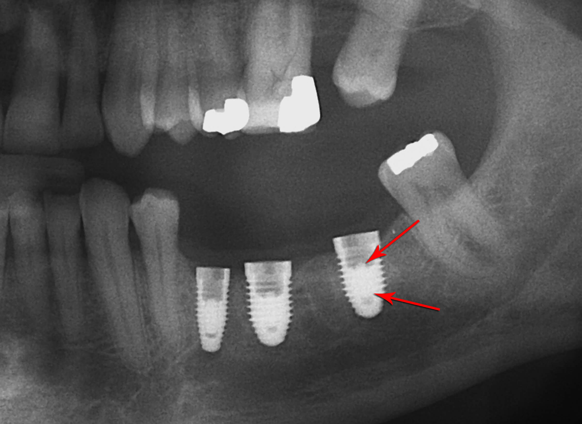 dental implants in Delhi