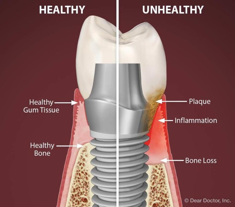Dental Implant Problems and How to Treat Them Live Enhanced