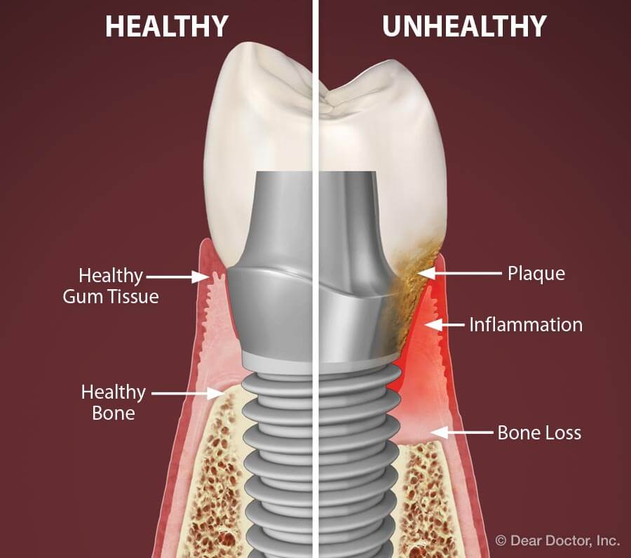 dental implants in Delhi