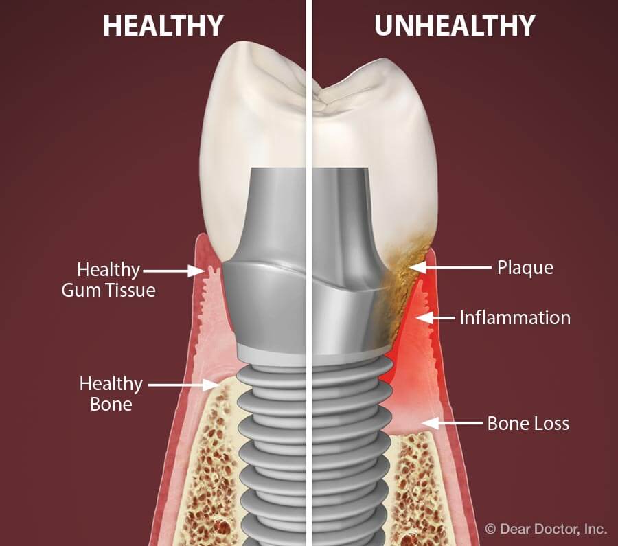 dental implants in Delhi
