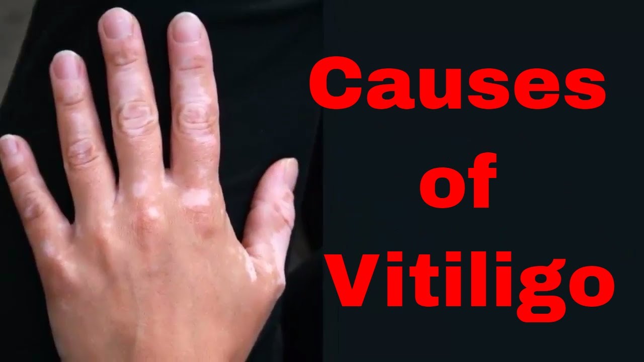 causes of Vitiligo