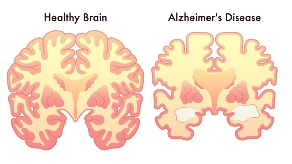 What is Alzheimer’s?