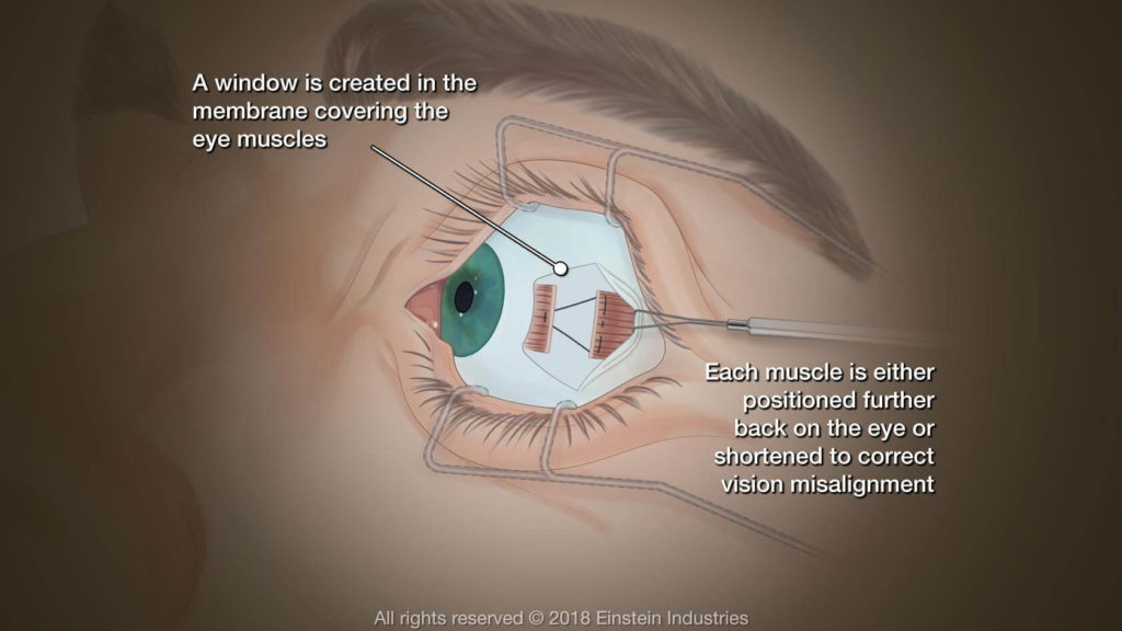 eye surgery 4 - Eye Muscle Surgery