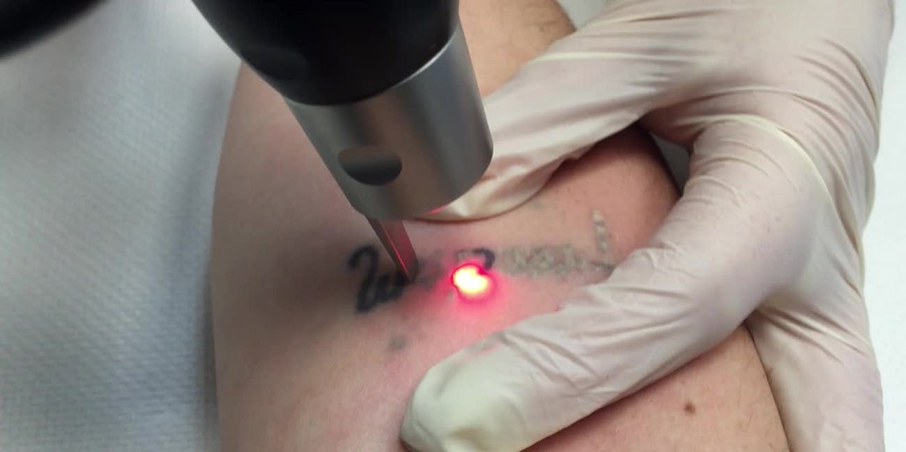 Things To Know Before Getting Laser Tattoo Removal