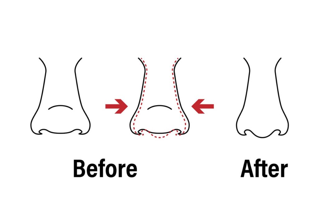 Guide to Getting Nose Thread Lift Procedure in Singapore - Live Enhanced