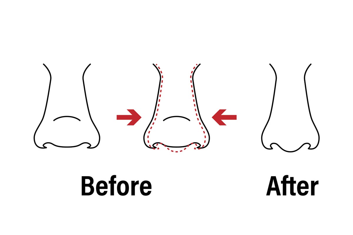 Vector illustration. Front view of a wide human nose before, after aesthetic plastic surgery - rhinoplasty nose job . Close up view. For advertising, medical and beauty publications. EPS 10.