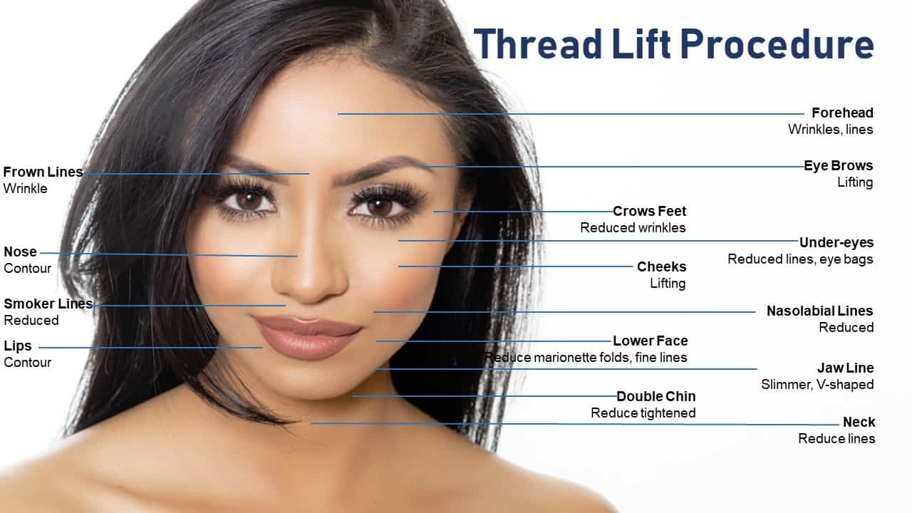 Advantages of Thread Lifts