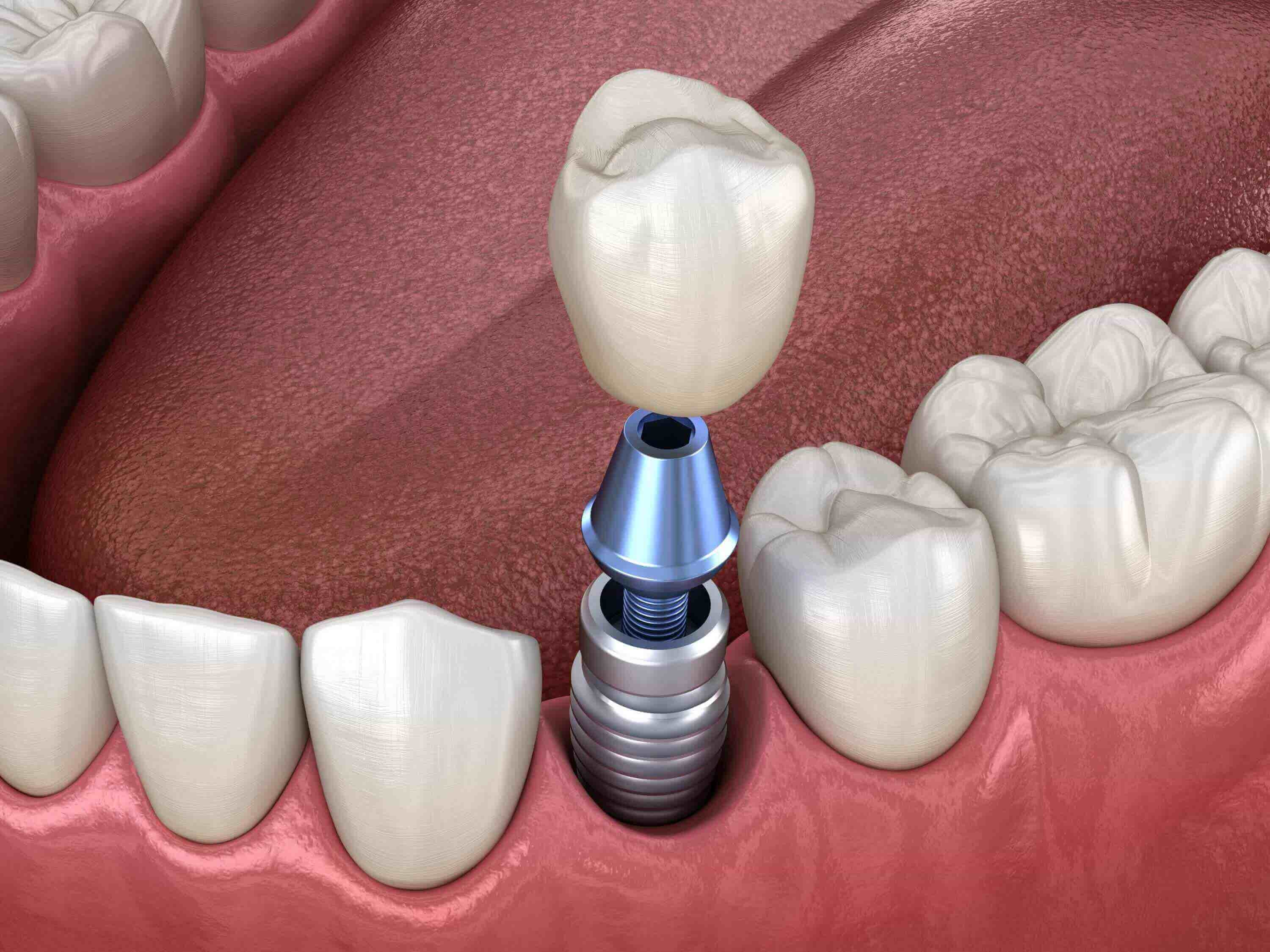 dental implant