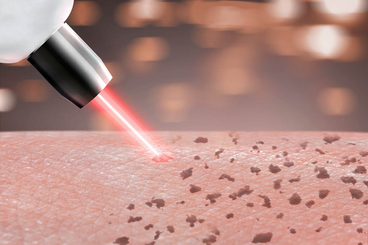 cosmetology procedure laser freckle skin removal on body parts. close up