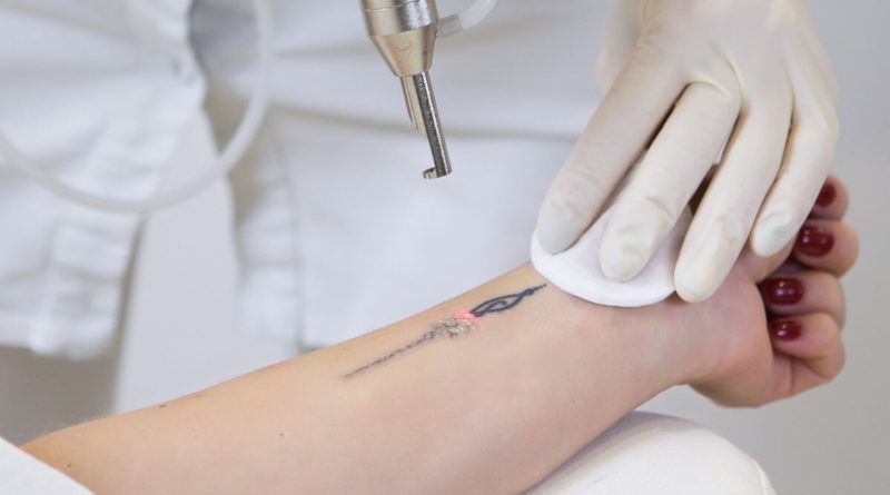 tattoo remove
