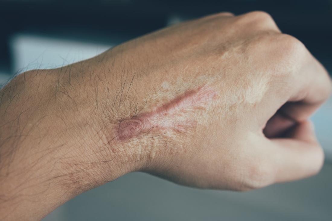 tattoo remove 