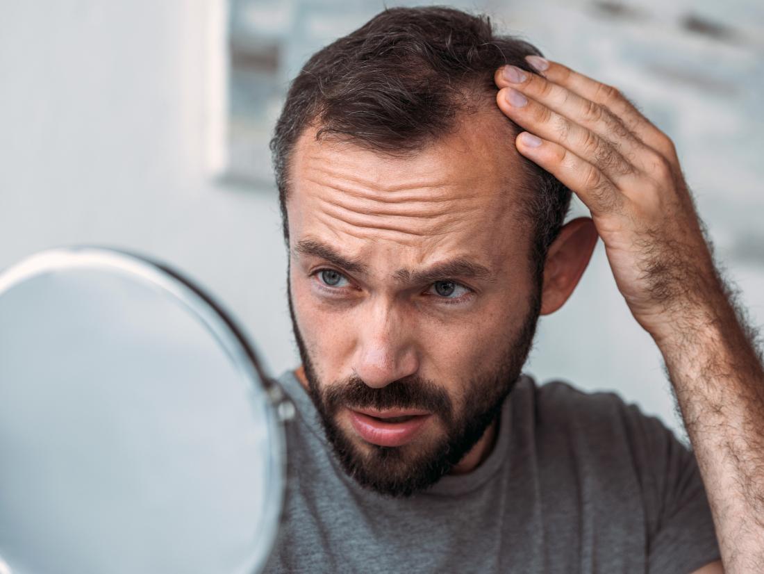 Hair Loss in Men