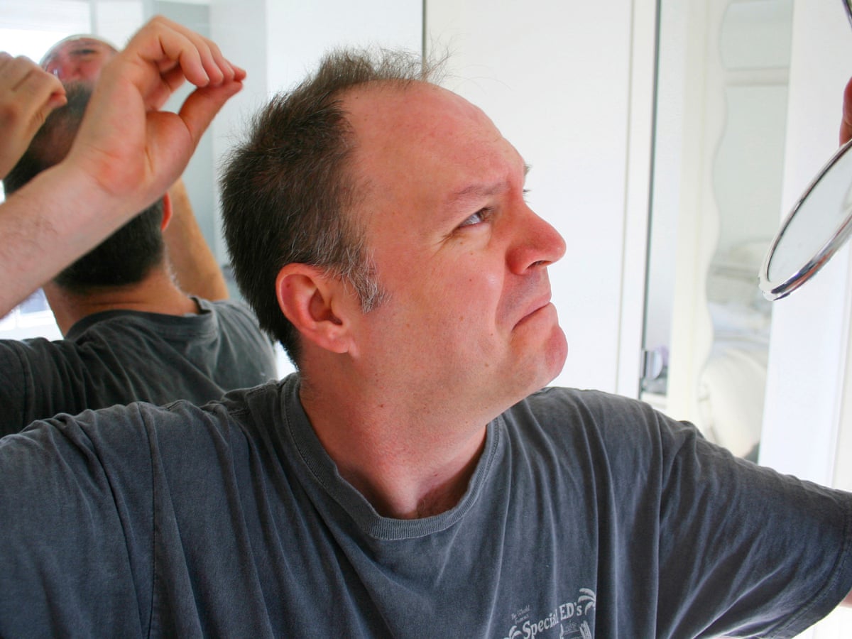 Hair Loss in Men