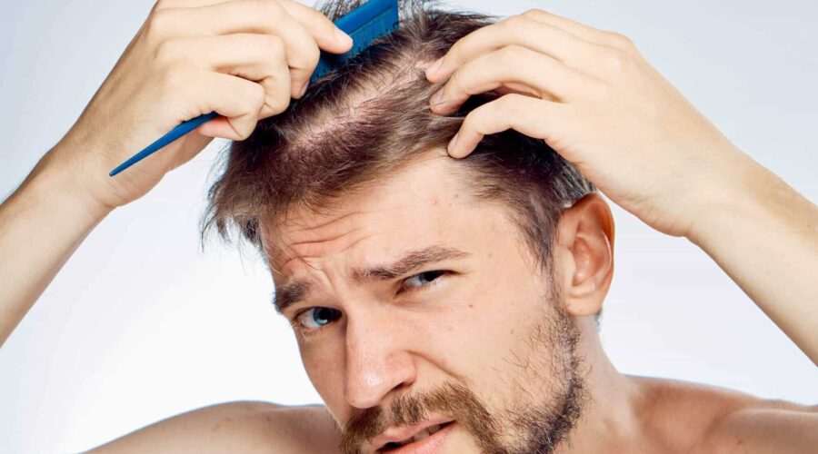 Hair Loss in Men