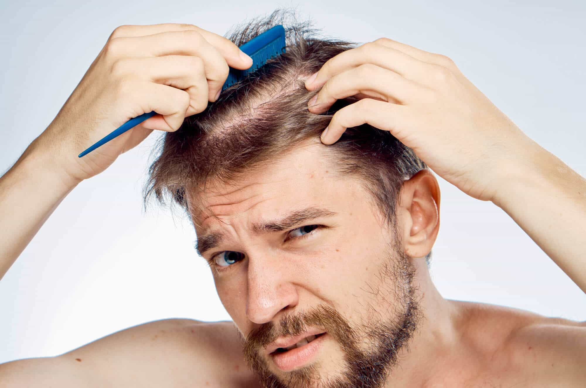 4 Common Causes of Hair Loss in Men - Live Enhanced