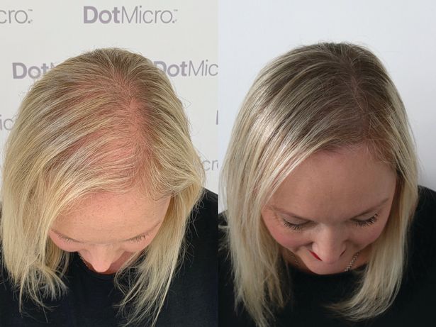 Micropigmentation 