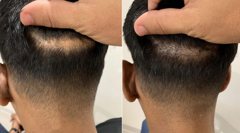 Micropigmentation vs Hair Transplants