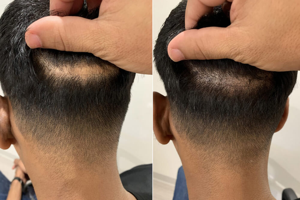 Micropigmentation vs Hair Transplants 