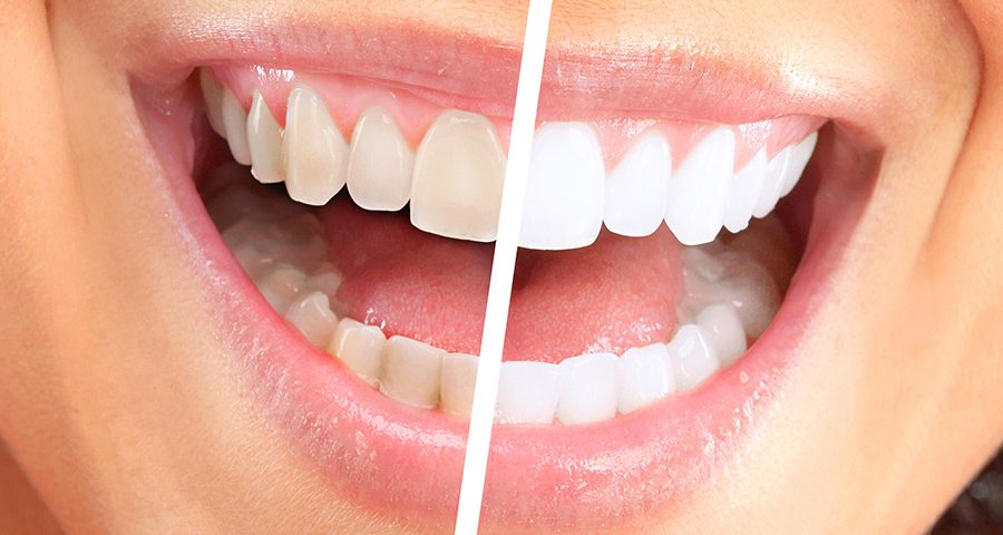 Over The Counter Whitening Worth 