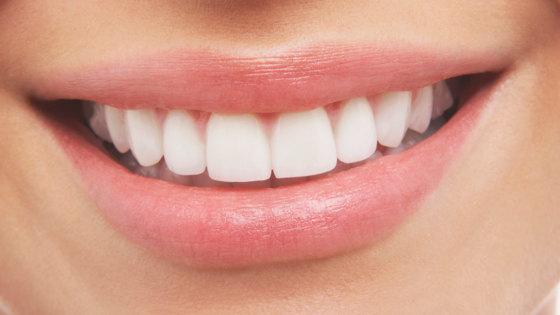 Over The Counter Whitening Worth 