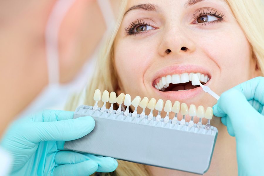 Over The Counter Whitening Worth 