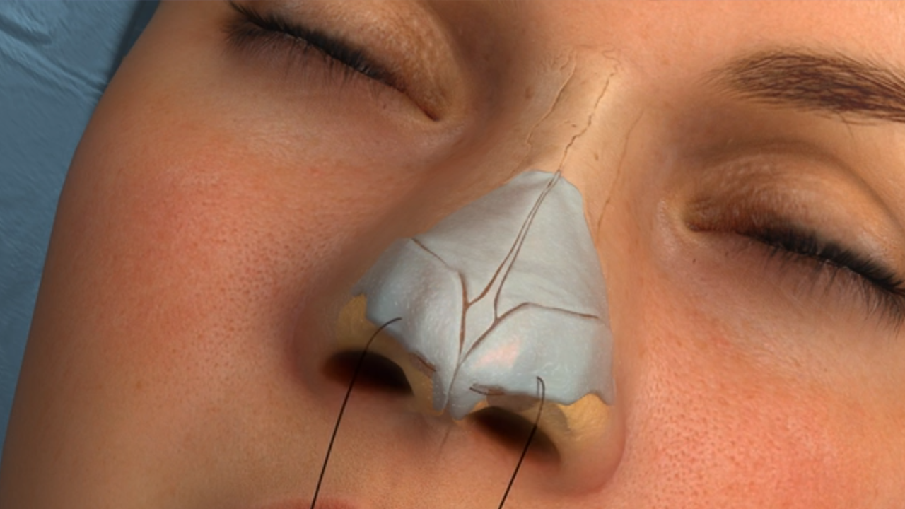 What is Rhinoplasty Surgical Procedure 