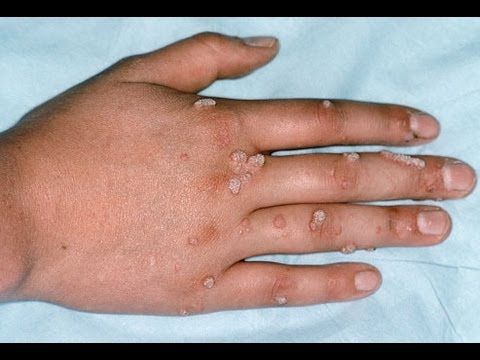 Monkeypox Virus 