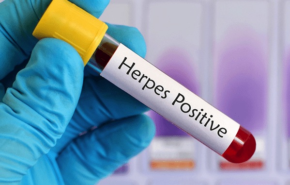 genital herpes treatment 