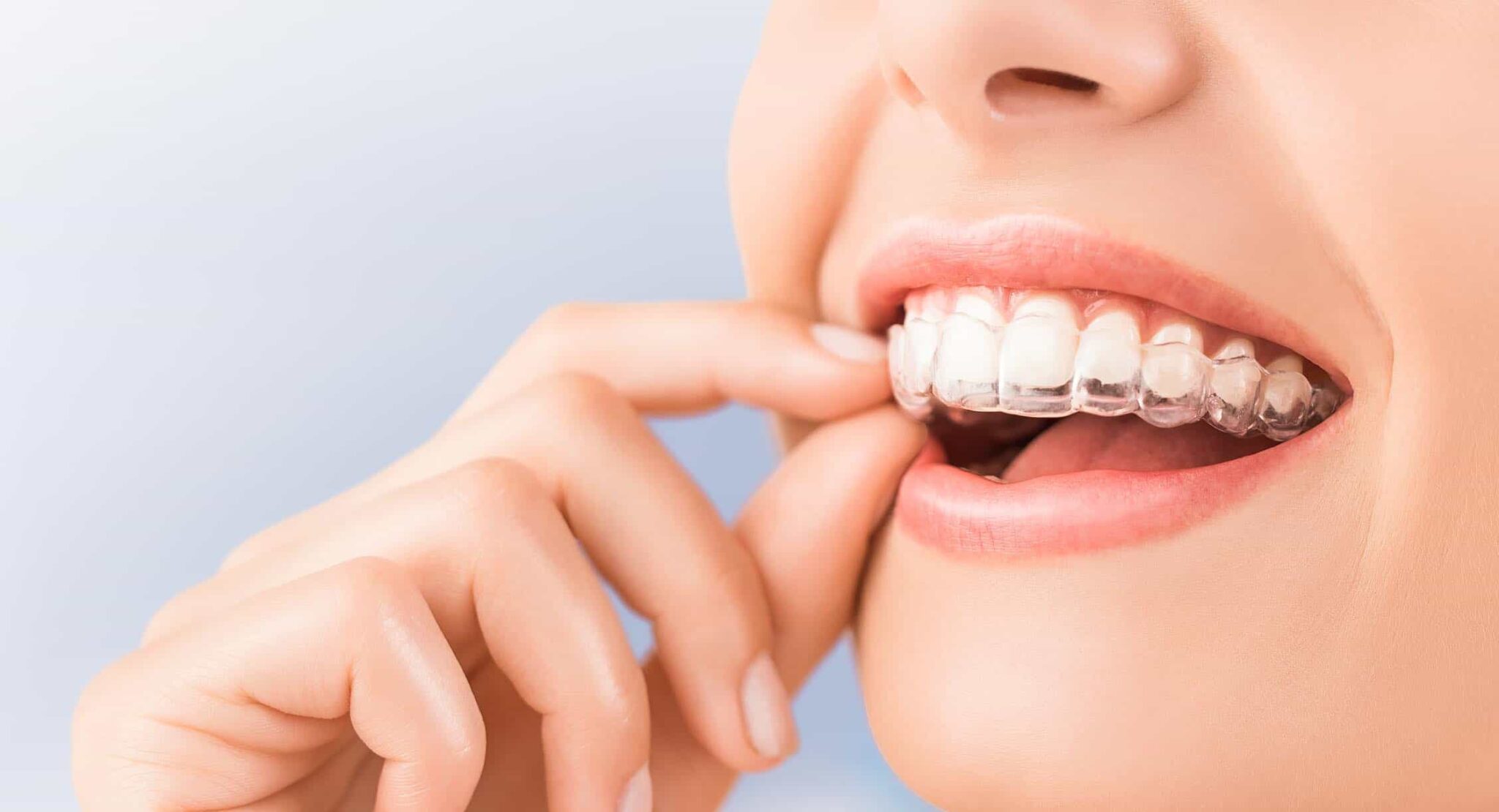 Ортодонтические капы 3d smile