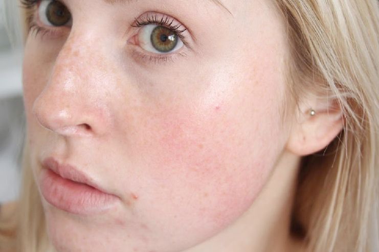 Get Rid Of Redness On Your Face