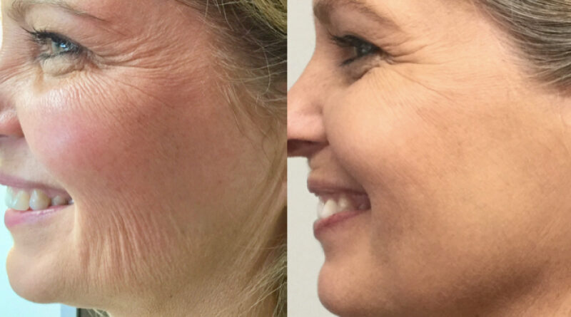 Morpheus 8 Before and After Results