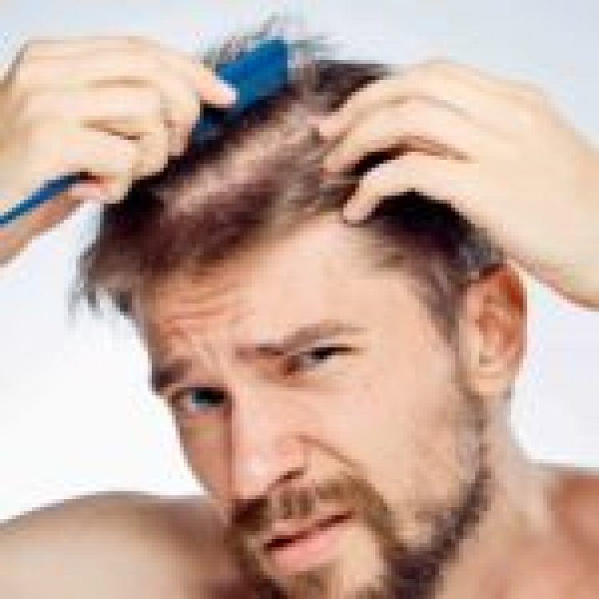 Hair Loss in Men