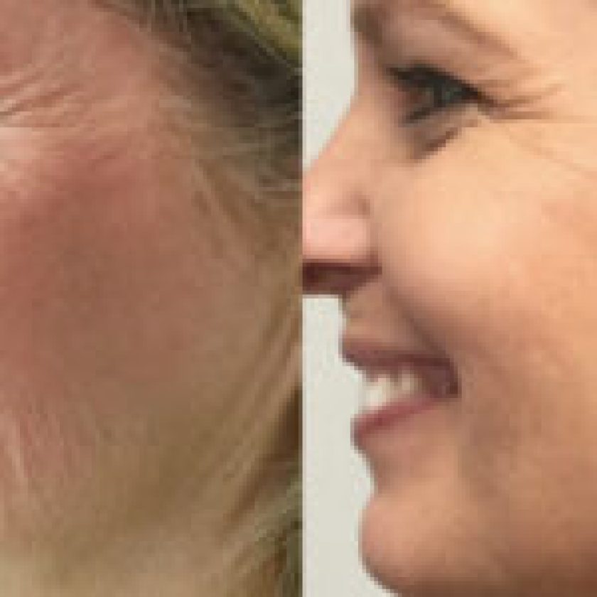Morpheus 8 Before and After Results