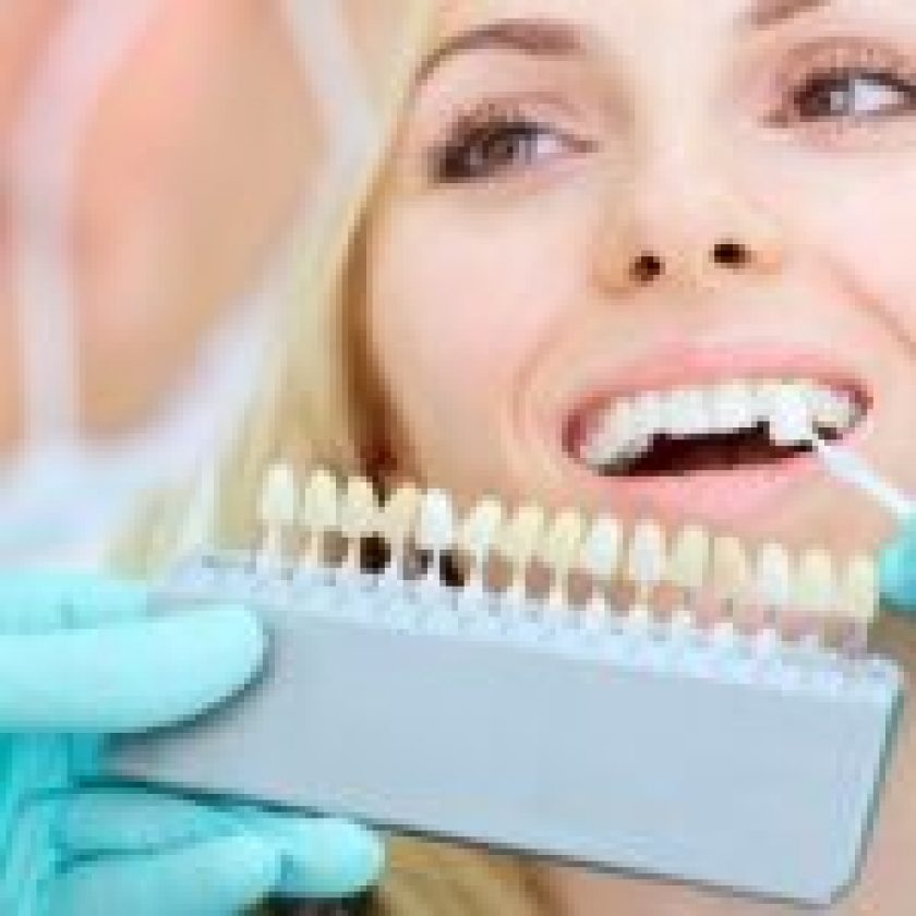 Over The Counter Whitening Worth